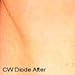 SDL80 Deluxe professionellen Einsatz Foto-Haarentfernung-System für dauerhafte Haarentfernung, Laser Resurfacing, allgemeine Dermatologie und mehr. 2 Jahre Garantie.