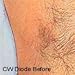 SDL80 Deluxe professionellen Einsatz Foto-Haarentfernung-System für dauerhafte Haarentfernung, Laser Resurfacing, allgemeine Dermatologie und mehr. 2 Jahre Garantie.