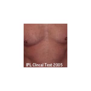 IPL800 professional salon quality ipl system for skin care, tattoo removal and permanent hair reduction treatments. 1… - Image 5
