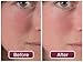 Wrinkle Filler by DermaWand - Instantly Reduces the Appearance of Wrinkles