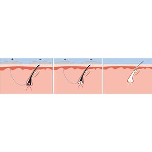 Medisana Hair Removal System EPD - Image 3