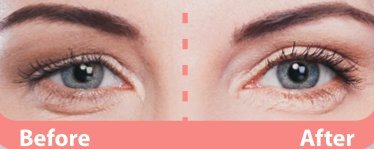 APRICOT SKIN® Eyelid Tapes / Schlupflidtape (96 Stück / Größe S+M) – für ein sofortiges Augenlid-Lifting! NEU! - 2