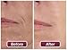 Wrinkle Filler by DermaWand - Instantly Reduces the Appearance of Wrinkles