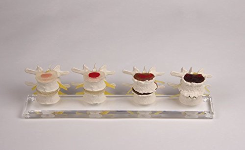 7577 Erler-Zimmer Stages of Disc Damage