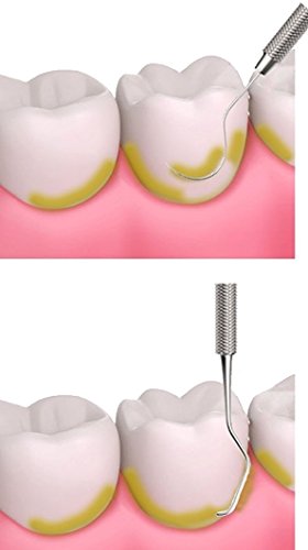 CANDURE® – 6er Dental Set Zahnreinigung Sonde – Rostfreier – zahnpflege zahnstein – Zahnmedizinischer Scaler – Dental Scaler – Zahnpflege Edelstahl Instrument Zahnkratzer hochwertige Profiqualität von CANDURE lebenslange Garantie - 6