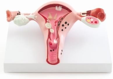 Uterus Model with Diseases