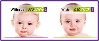 Otostick® Bebe kosmetische korrekturteile für abstehende ohren - 2