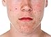 Sulphur 10 % Sulphur Soap Great For Acne Blackheads and Spots Treatment Helps Blocked Pores and Oily Skin and Fights Against Psoriasis, Dandruff, Seborrheic Dermatitis and Eczema - Special Offer 300grams