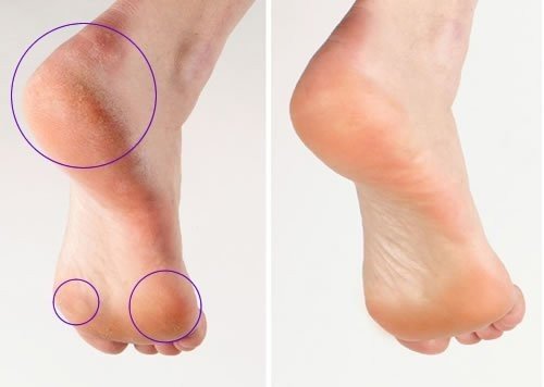 Silk’n Hornhautentferner Nachfüll-Rollen, Medium und Soft, Micro Pedi Refills, Blau/Rot - 3