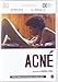 Acné (Import Dvd) (2011) Alejandro Tocar; Yoel Bercovici; Igal Label; Gustavo