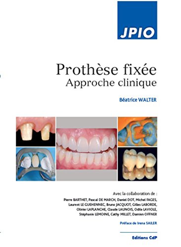 Prothèse fixée : Approche fixée