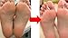 BEST RATED Baby Foot Peeling Mask by Grace & Stella® - Odor Eliminator & Callus Remover - 100% Money-Back Guarantee - Deep Peel Pedicure - Soft Feet Exfoliant Spa Treatment (UK Seller)