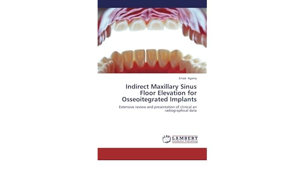 Buy Indirect Maxillary Sinus Floor Elevation For Osseoitegrated