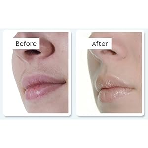no!no! Thermicon 8800 Face & Body Complete Painless Hair Removal System - Heat Treatment For Short & Long Term Results… - Image 2