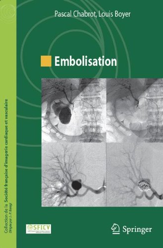 Download Embolisation Download Embolisation