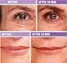 freezeframe wrinkle FILLER