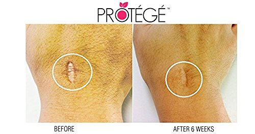 Narbengel – FLAWless – Natürliche Schadenbehebungskur + Für Narben und Wulstnarben (Keloide) + Aknenarben + Operationsnarben + Reduziert Rötungen & Kupferrosen (Rosazea) & Besenreiser + konzentrierte Formel (30ml) - 8