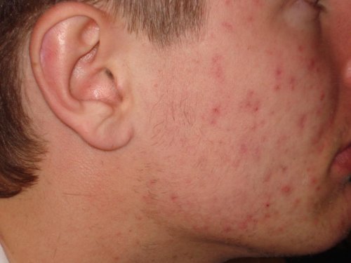 JB repair+care Nachtkerze “ Silber aktiv „… mit dem Silber- / Sauerstoff Komplex, bei Pickeln und Akne, sowie verstopfte Poren - 3