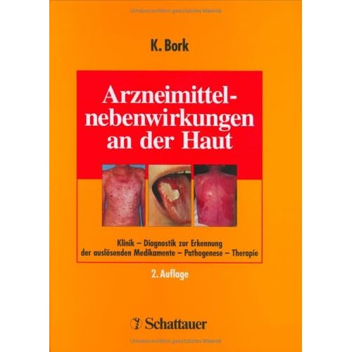 [PDF] Arzneimittelnebenwirkungen an der Haut: Klinik - Diagnostik zur Erkennung der auslösenden Medikamente - Pathogenese - Therapie KOSTENLOS DOWNLOAD