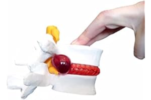 RACKBONE Mike-Dental Modello per prolasso del disco vertebrale con ernia lombare, anatomia umana medicale