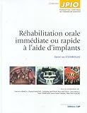 Image de Réhabilitation orale immédiate ou rapide à l'aide d'implants