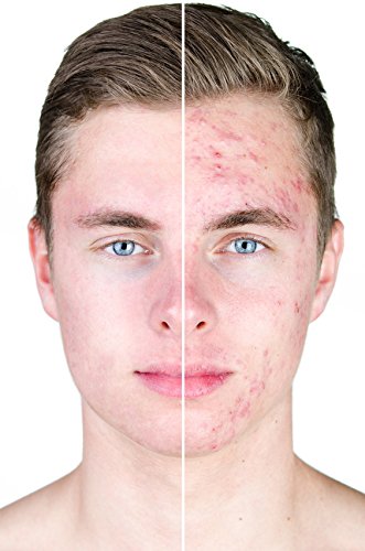 AktivLehm | Anwendung bei Akne, unreiner Haut, Cellulite, Bindegewebsschwäche, Schwangerschaftsstreifen, Neurodermitis, Mundgeruch, Fußgeruch, Hornhaut, Fußpilz, gegen starkes Schwitzen (Achsel-, Fuß- und Körperschweiß), als natürliche Zahnpasta. - 4