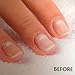 Vitry Nail Repair Treatment