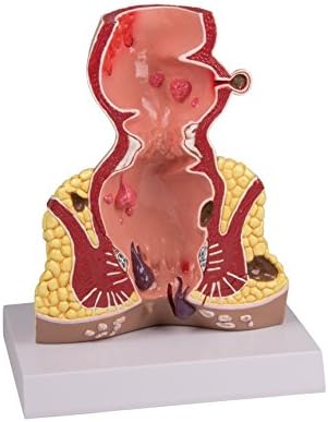 Rectum, 1.5 times life size
