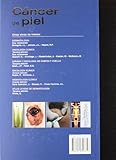 Image de Cáncer de piel + CD-ROM de imágenes