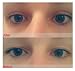 1000PCS/500Pairs Portable Breathable Naturally Invisible Double Eyelid Tape Self-Adhesive Double Eyelid Stickers Instant Eye Lift Strips With Portable Packing Box (Yellow Box)