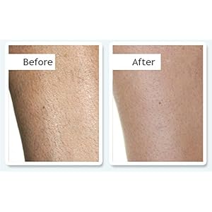 no!no! Thermicon 8800 Face & Body Complete Painless Hair Removal System - Heat Treatment For Short & Long Term Results… - Image 3