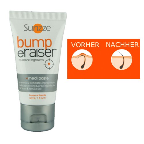Sunzze Bumperaiser Medipaste Treatment Ingrown Hair, No more ingrowns