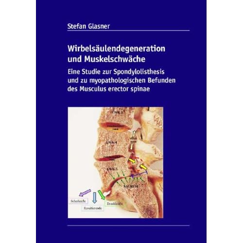[PDF] Wirbelsáulendegeneration und Muskelschwáche: Eine Studie zur Spondylolisthesis und zu myopathologischen Befunden des Musculus erector spinae KOSTENLOS DOWNLOAD