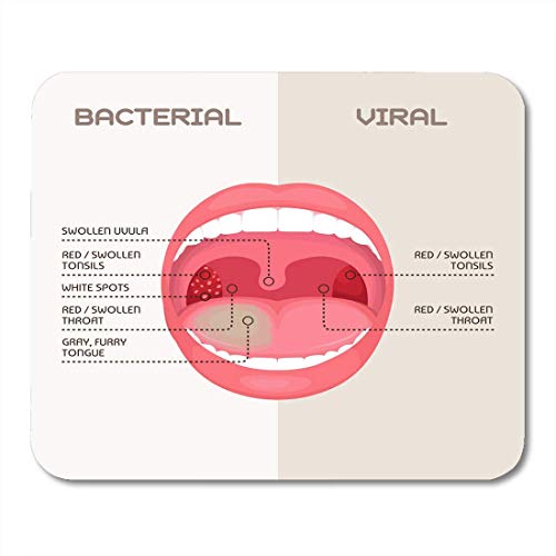 Preisvergleich Produktbild Mauspads Bakterien Anatomie des Halses Bakterielle und virale Infektion Mandeln Entzündung Angina Disease Mauspad für Notebooks, Desktop-Computer Matten Bürobedarf