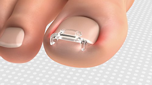 Scholl Eingewachsene Zehennägel Komplett Set: Clips & Spray - 2