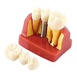 Modèle De Dents Analyse Des Implants Dentaires En Résine Démonstration Du Pont De La Couronne Organisation Dentaire 1 PC