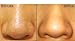 Premium Quality Face Facial Skin Care Set Kit of 2 Eye Hole Blackheads Removers Acne Pimples Extractors Tools By VAGA®