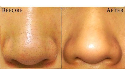 Eye Hole Design Facial Mitesserentferner Akne Pickelheber von Cheeky® - 6