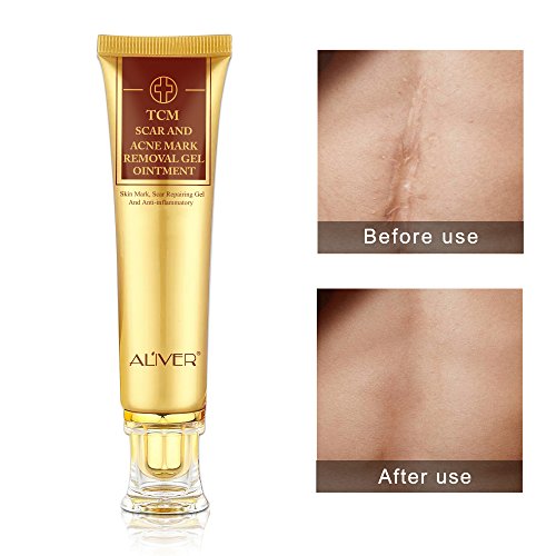 TCM Scar und Akne Mark Removal Gel Creme Salbe, entzündungshemmende und Rapairing, Akne Narbe Entfernung Creme Skin Repair Gesichtscreme Akne Flecken Akne Behandlung Blackhead Stretch Marks 30ml