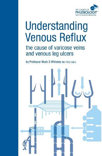 Understanding Venous Reflux the Cause of Varicose Veins and Venous Leg Ulcers: Varicose veins and venous leg ulcers (College of Phlebology)