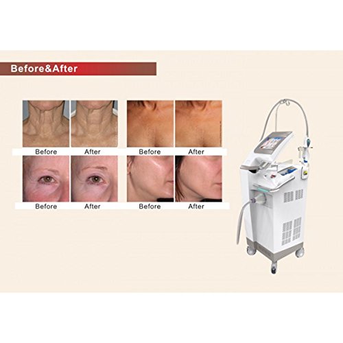 Laser Hair Removal Machine