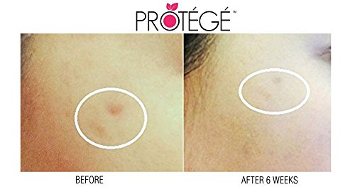 Narbengel – FLAWless – Natürliche Schadenbehebungskur + Für Narben und Wulstnarben (Keloide) + Aknenarben + Operationsnarben + Reduziert Rötungen & Kupferrosen (Rosazea) & Besenreiser + konzentrierte Formel (30ml) - 7