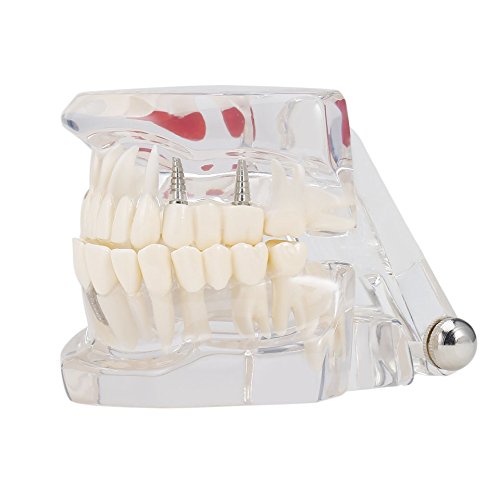 Buy Professional Detachable Fake Tooth Teeth Disease Moldel Dental Im