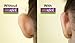 Otostick - TWIN PACK - Instant Correction for Prominent Ears