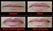 FULLIPS LIP ENHANCERS - Medium/Large Set w/ Bonus Small!!!