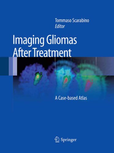 Imaging Gliomas After Treatment: A Case-based Atlas (English Edition)