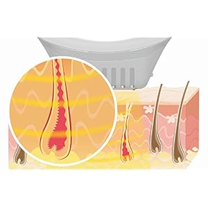 Beurer Salon Pro Permanent Hair Removal System with Life Time Flash - Image 14
