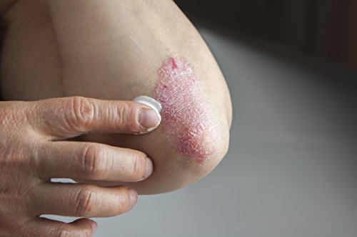 Pflege bei Schuppenflechte (Psoriasis) und trockener, juckender und schuppiger Haut – PsoriCol Salbe 100ml (~90g) – Creme mit wertvollen Pflanzenextrakten (Curcuma, Wrigthia Tinctoria, Rubia Cordifolia) und natürlichen Ölen (Kokosnuss, Shea Butter, Neem). - 5
