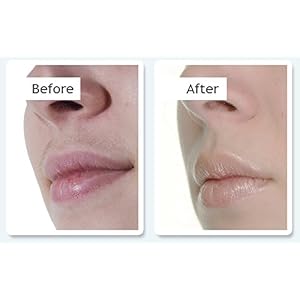 no!no! Thermicon Micro Home Facial and Body Hair Removal System for Women | Ladies Hair Remover Machine for Face, Body… - Image 6