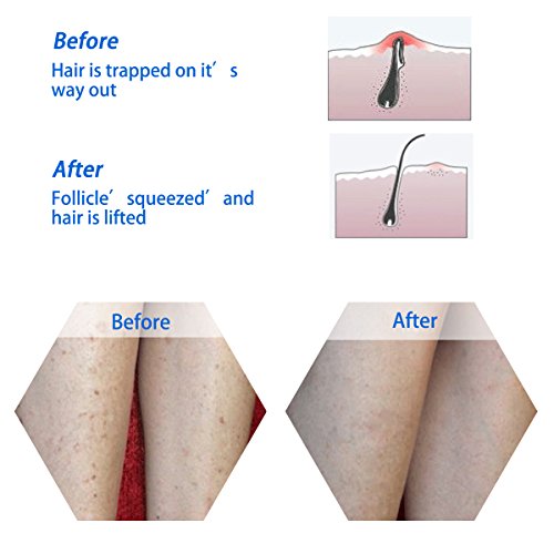 Codream Bristle Massage Brush For Eliminating Razor Bumps And